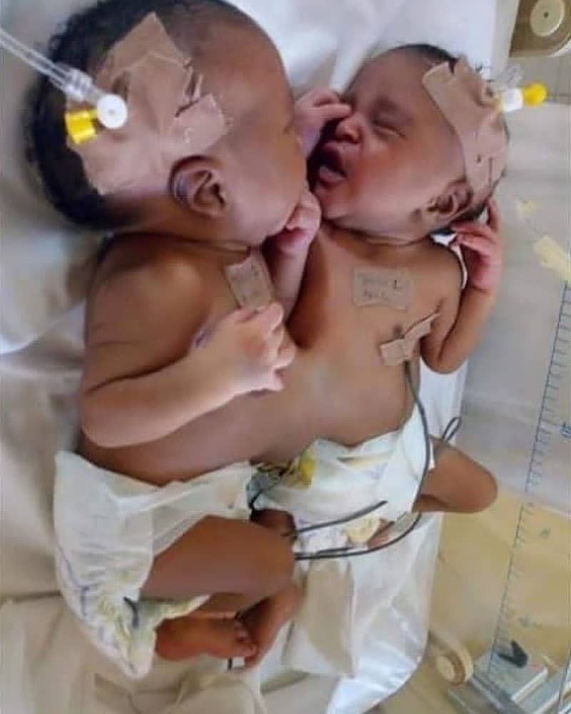 Operation De Separation De Bebes Siamois Reussie Au Nigeria Photo L Frii