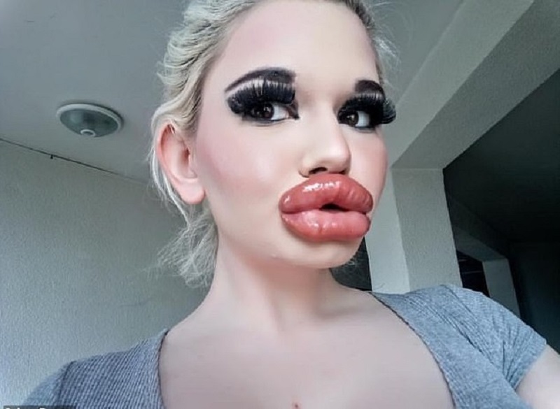 Bulgarie-une-jeune-dame-accroc-aux-injections-dans-ses-levres-pour-etre-belle-video