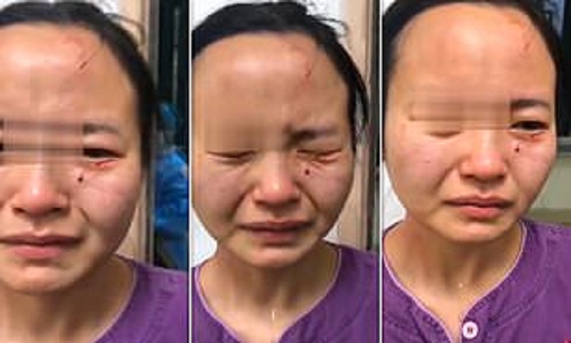 Chine-Pour-fuir-la-quarantaine-il-mord-sauvagement-le-visage-dune-infirmiere-Photo-Video