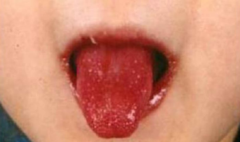 Comme-un-zombie-cet-enfant-a-souffert-de-la-maladie-de-Kawasaki-soupconnee-detre-liee-au-coronavirus
