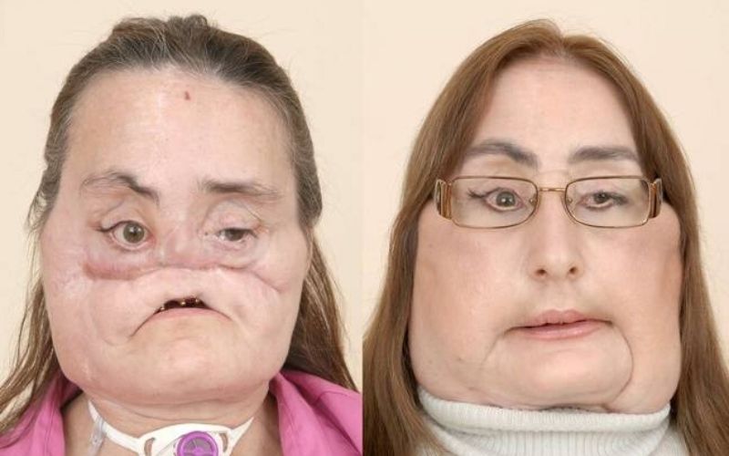Deces-de-la-premiere-Americaine-ayant-recu-une-greffe-de-visage