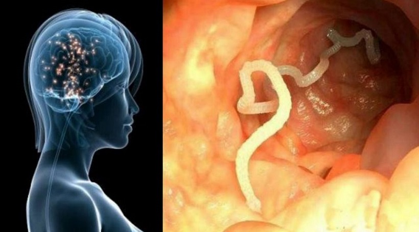 Il-vit-avec-un-ver-solitaire-dans-le-cerveau-pendant-10-ans-photo