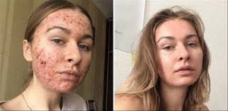 Le-chocolat-a-ruine-ma-peau-et-ma-vie-sociale