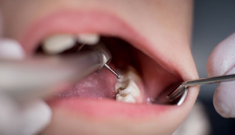 Opere-il-y-a-15-ans-il-decouvre-une-aiguille-oubliee-dans-sa-gencive-photo