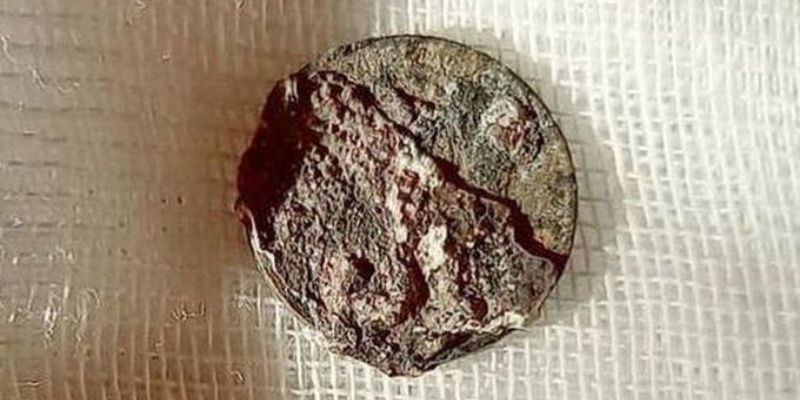 Une-piece-vielle-de-50-ans-sortie-du-nez-dun-patient-photo-2