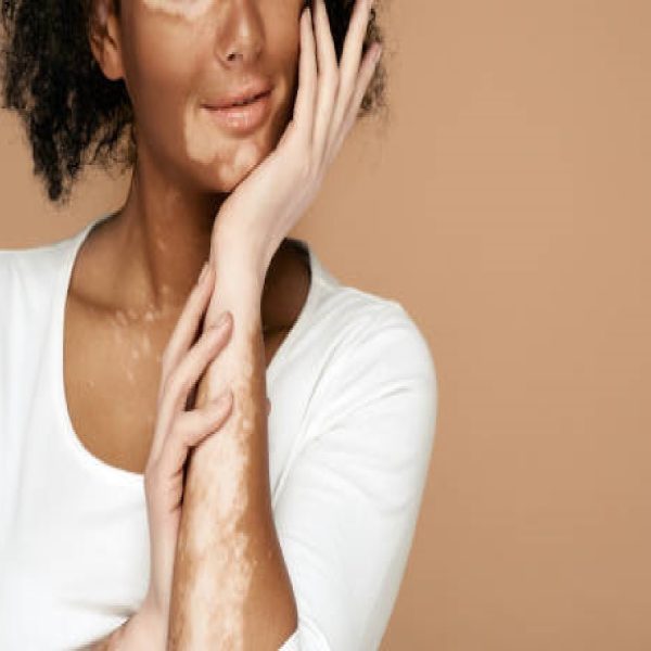 Young woman demonstrates her skin spots on her hands and face with vitiligo